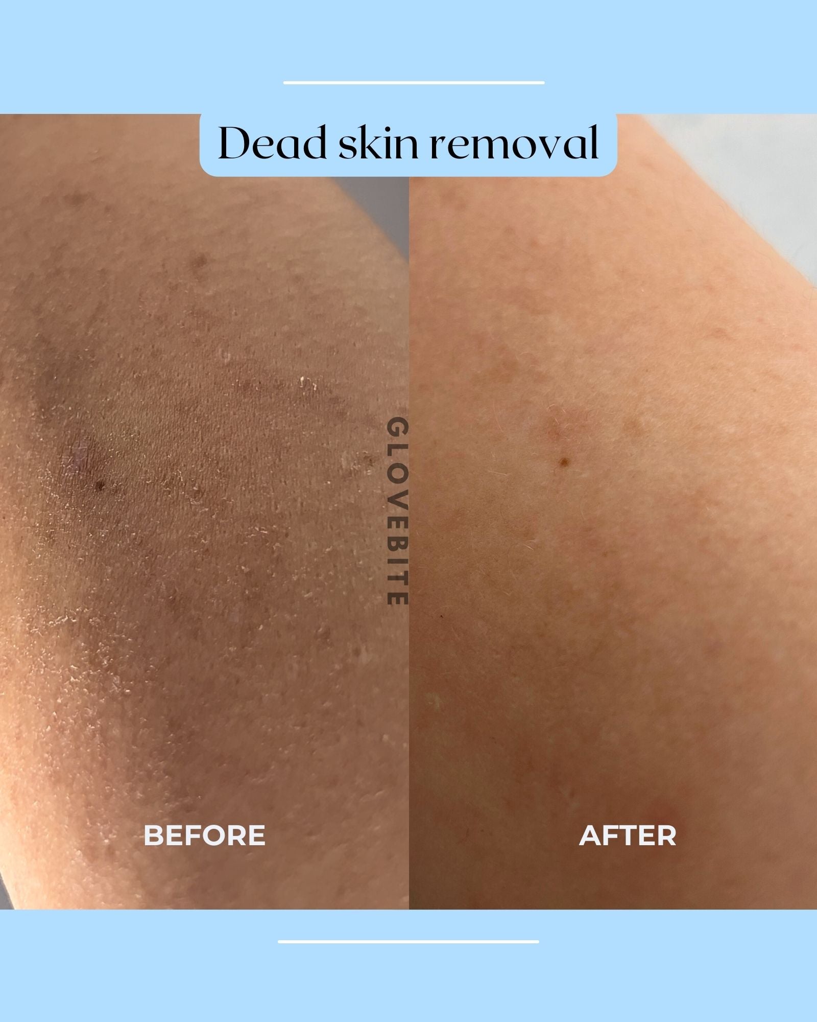 Enhance skincare routine with silk exfoliating body gloves. Achieve smooth, blemish-free skin, reduce strawberry skin, and improve keratosis pilaris. Buy now!